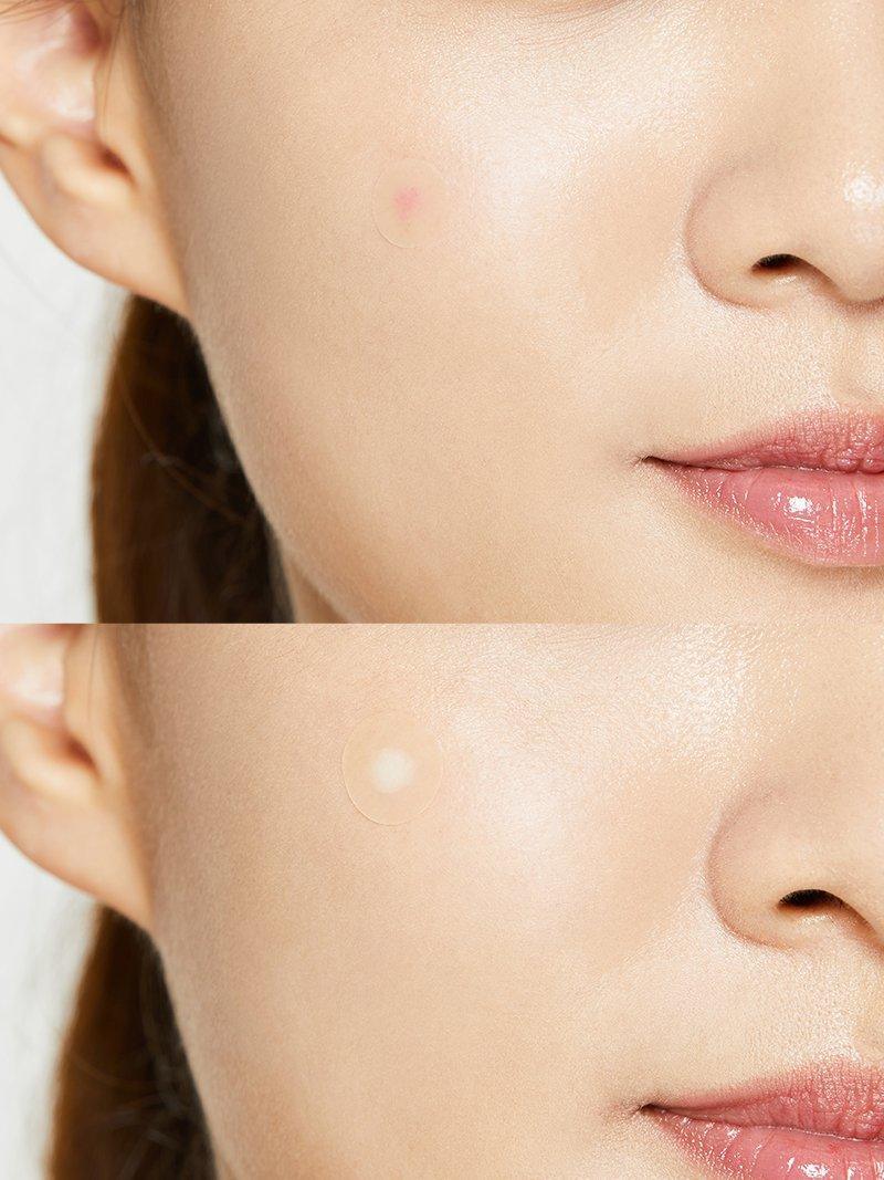 Cosrx Acne Pimple Master Patch (24 Patches) - Image 2